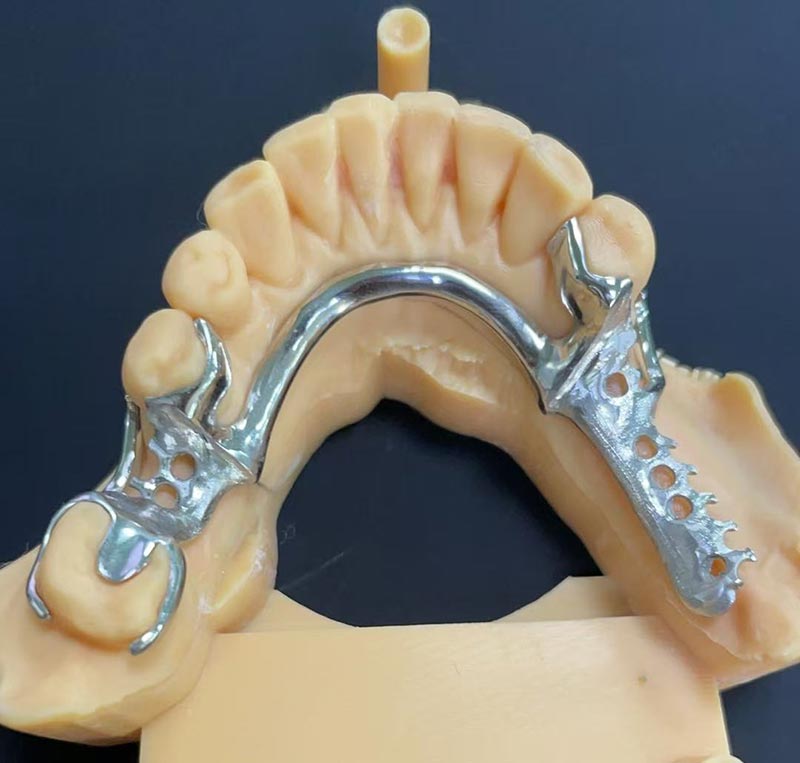 கோபால்ட்-குரோமியம் கட்டமைப்பின் நன்மைகள் (Co Cr Framework)