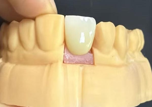 பற்களுக்கு இடையே உள்ள இடைவெளிகளை சரிசெய்யலாம் - நேரான பற்கள் மிகவும் கவர்ச்சிகரமானவை!