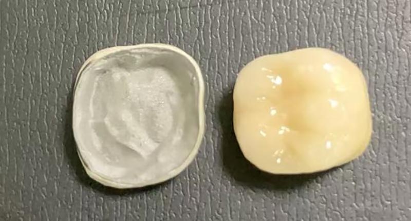 உங்கள் பீங்கான் கிரவுன் சிப்ஸ் போது என்ன செய்ய வேண்டும்? இது ஏன் நடக்கிறது & அதை எவ்வாறு சரிசெய்வது என்பது இங்கே