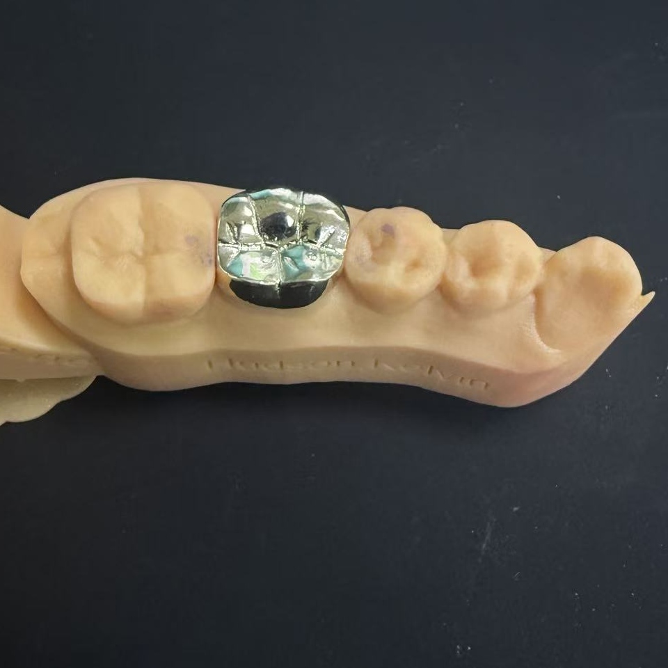 தங்க கிரீடங்கள்: வாழ்நாள் முழுவதும் பல் மறுசீரமைப்புக்கான விலைமதிப்பற்ற உலோகத் தேர்வு