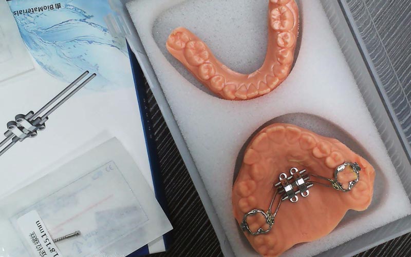 WM பல் ஆய்வகத்துடன் MSE எலும்பு விரிவாக்கத்தைப் புரிந்து கொள்ளுங்கள்