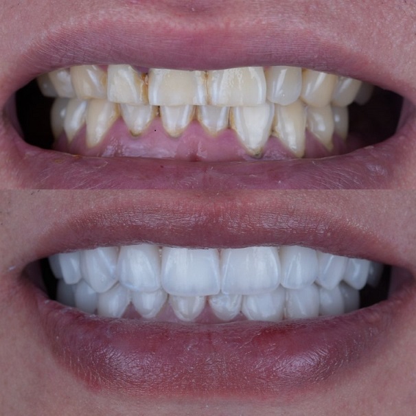 Emax Layered Veneers Esthetic China Dental Lab வேலை