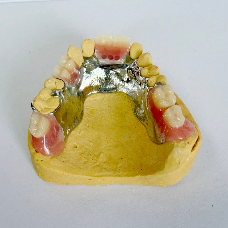 நீக்கக்கூடிய மறுசீரமைப்பு பகுதி கட்டமைப்பு